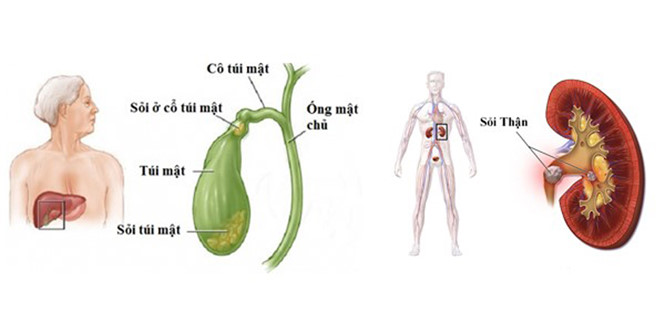 Điều trị sỏi mật, sỏi thận, sỏi gan hiệu quả từ hỗn hợp dược liệu tự nhiên