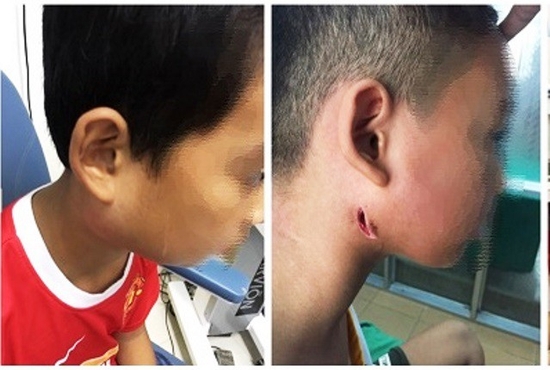 Bệnh nhi mắc vi khuẩn ‘ăn thịt người’ sức khỏe tiến triển tốt