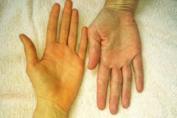 Sau Tết, gan dễ bị tổn thương, gây bệnh nguy hiểm: Dấu hiệu cảnh báo sớm cần đi khám ngay
