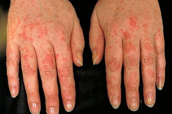 Dị ứng nước: triệu chứng, nguyên nhân và cách khắc phục
